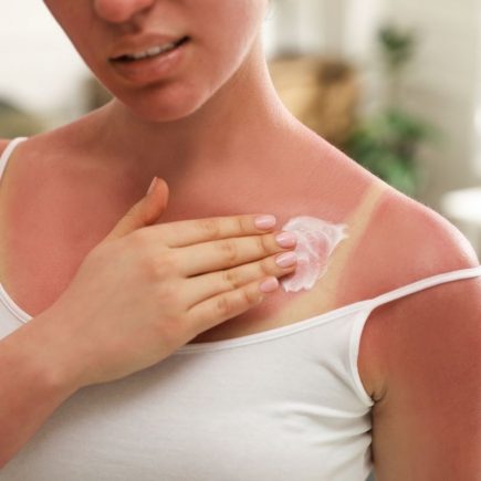 comment faire dérougir un coup de soleil