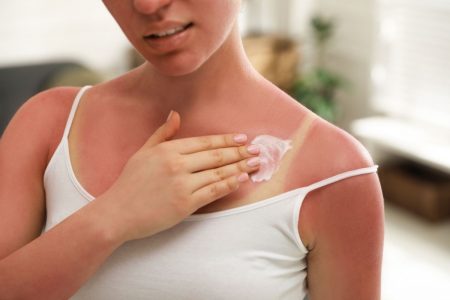 comment faire dérougir un coup de soleil